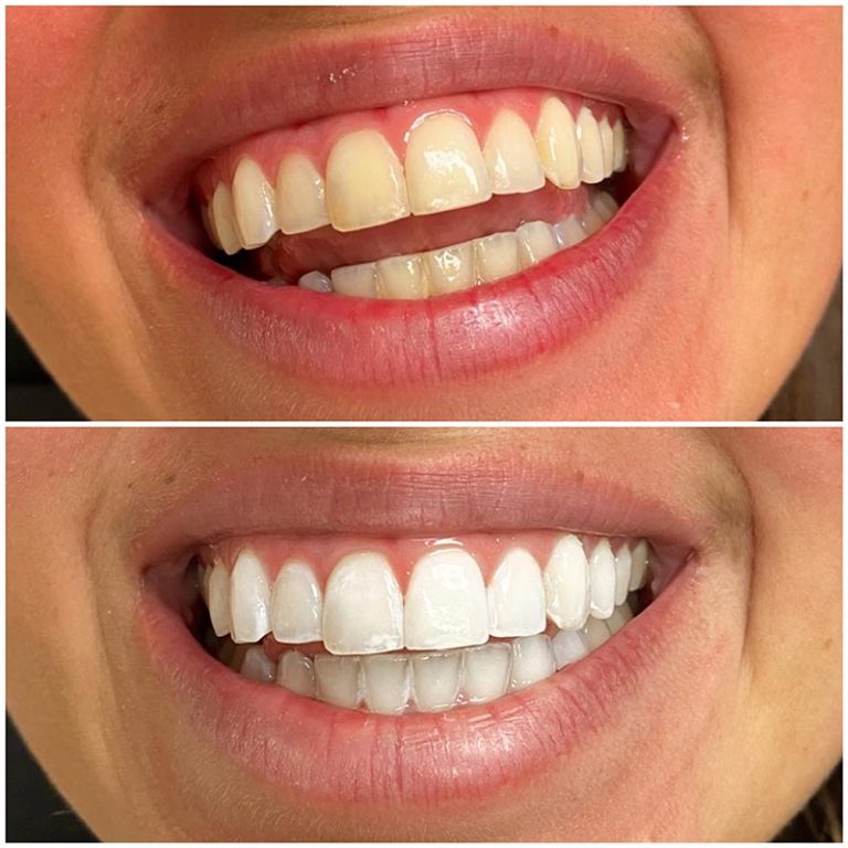 Best DFW Teeth Whitening & Bleaching Service Fort Worth Photo Gallery