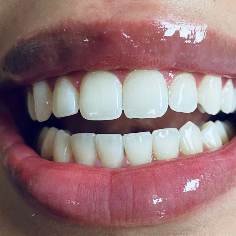 Best DFW Teeth Whitening & Bleaching Service Fort Worth Photo Gallery