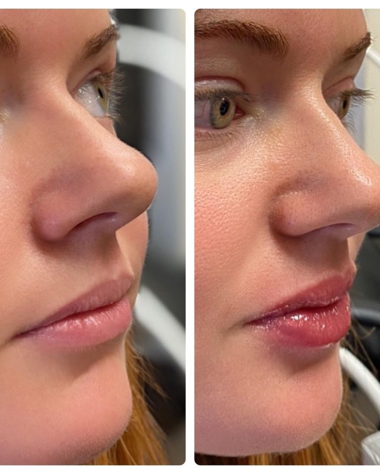 Needleless lip filler crazenipod